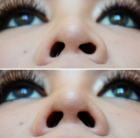 non surgical rhinoplasty