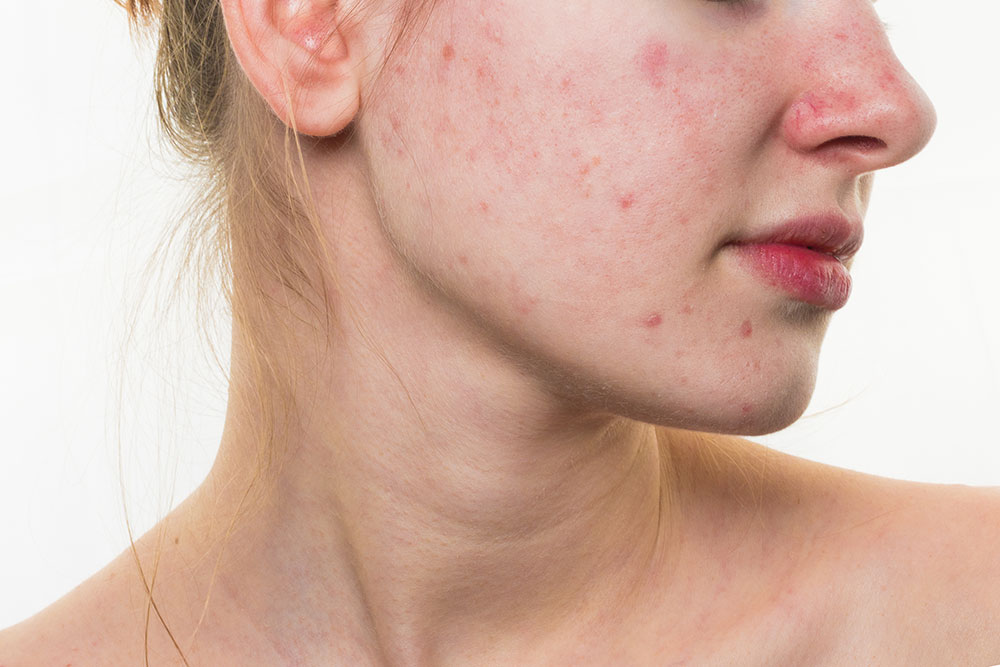 pimples on neck