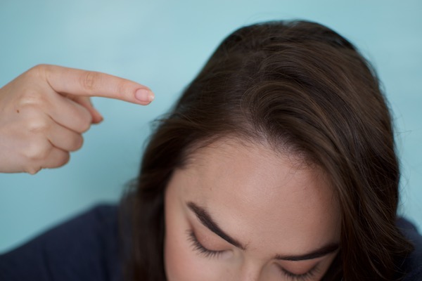 what causes scalp acne