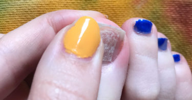 cracked toenail repair