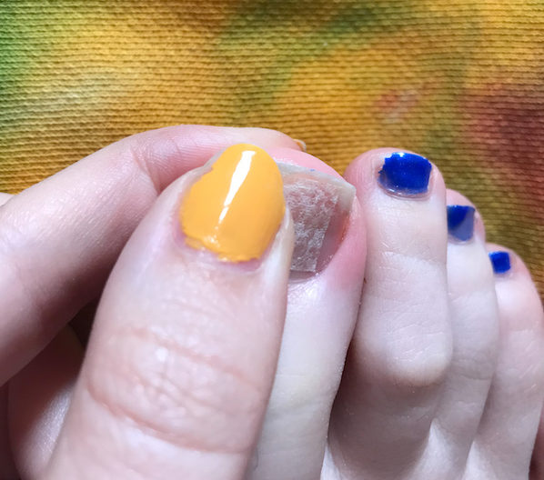 cracked toenail repair