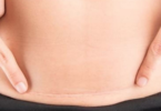 c-section scar healing