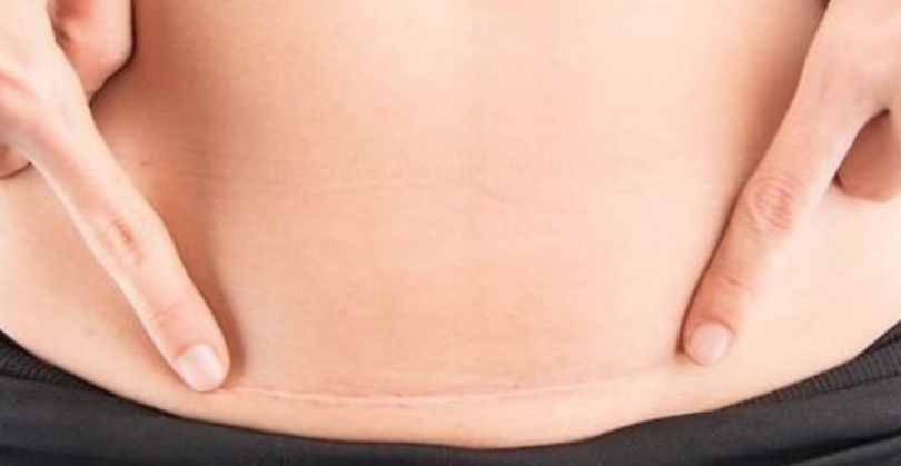 c-section scar healing