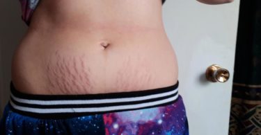 breast milk for stretch marks