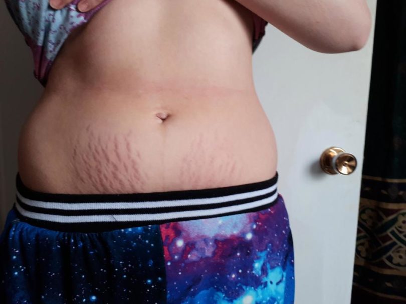 breast milk for stretch marks