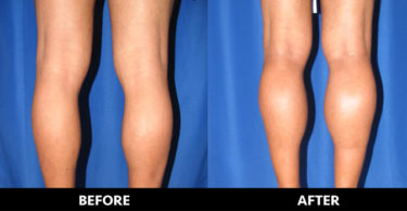 how much do calf implants cost