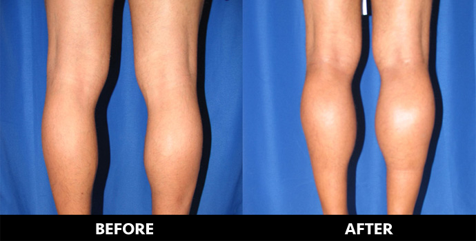 how much do calf implants cost